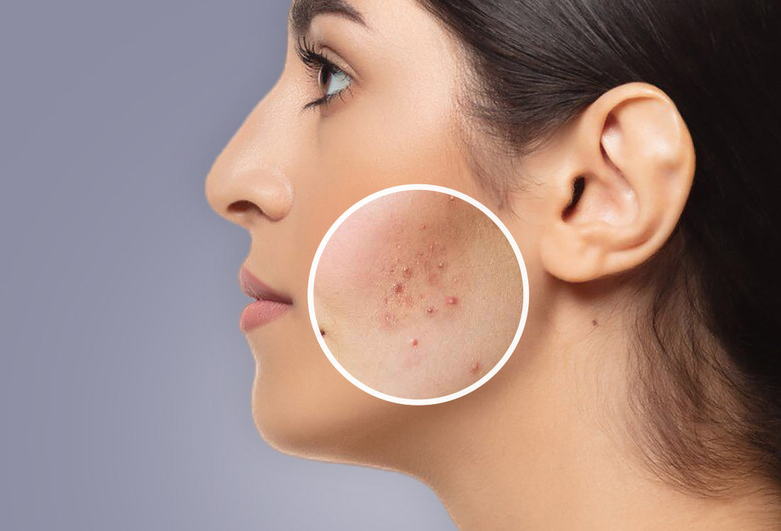 Acne 101: Everything You Need to Know About Breakouts