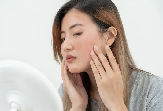 Hormonal Havoc: Here's the Truth About Hormonal Acne